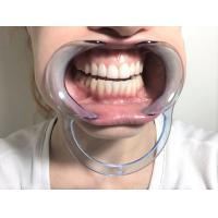 C型口外唇开口器 透明