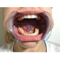 H型口内唇开口器  透明
